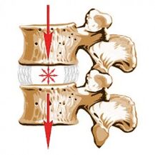 Uređaj kralježnice i uzroci osteohondroze