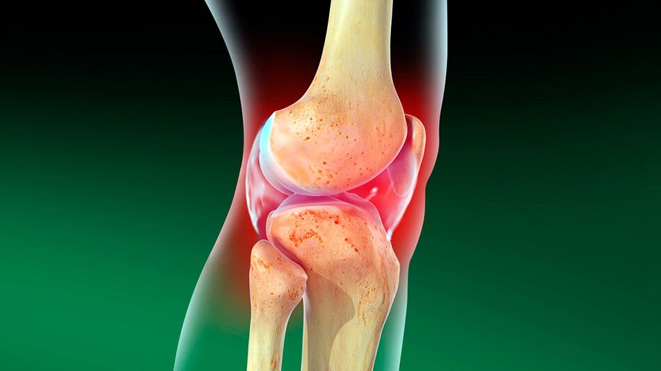 Osteoartritis zgloba koljena